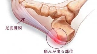 足底腱膜炎という症状をご存知ですか？