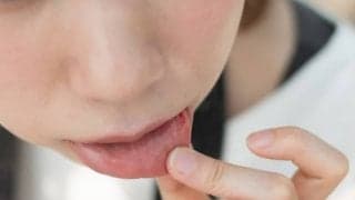 肌荒れ・口内炎に効く栄養素って？