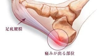 足底腱膜炎という症状をご存知ですか？